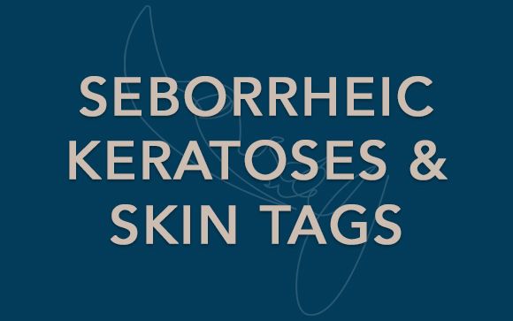 seborrheic keratoses and skin tags