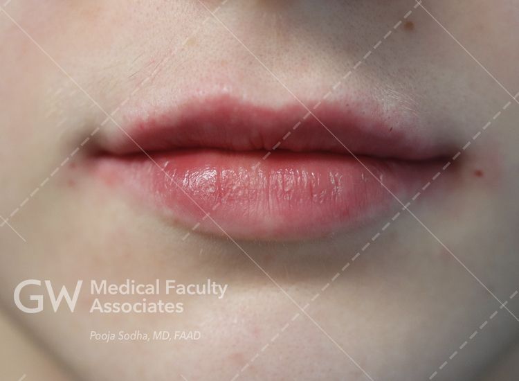 case three post-treatment lips
