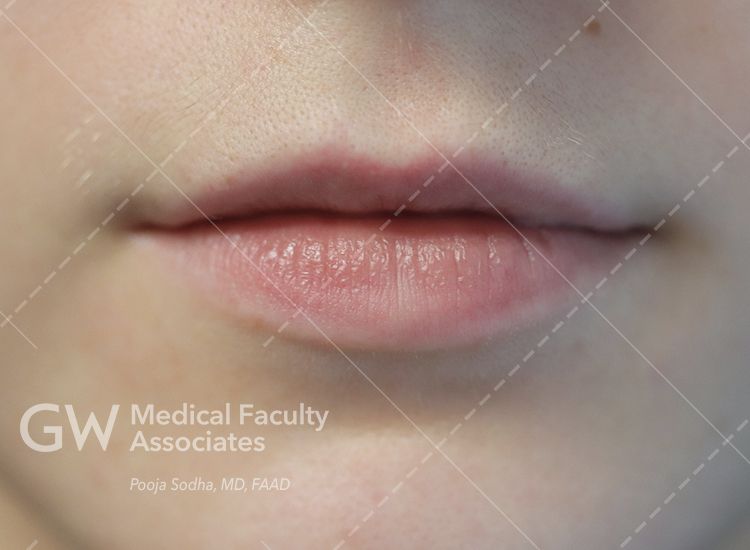 case three lips pre-treatment